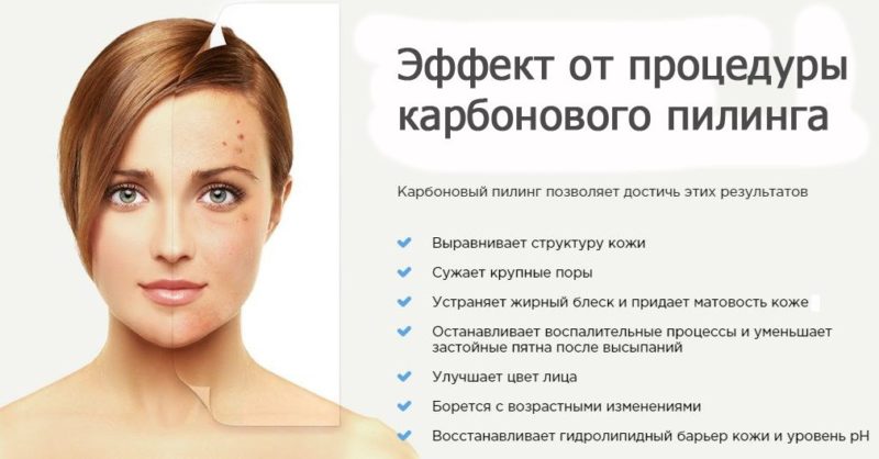 Карбоновый пилинг