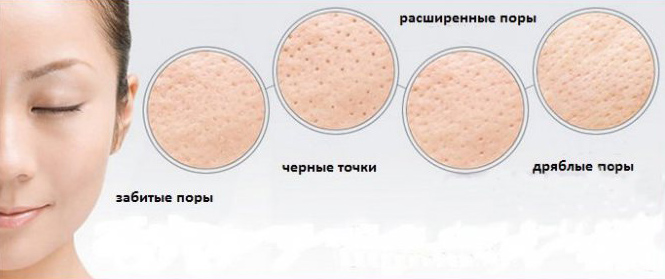 Расширенные поры